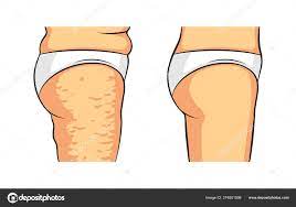 cellulite-medical-herb-lab